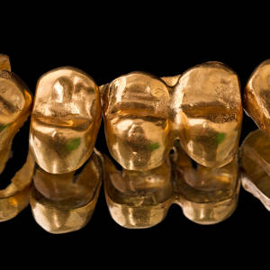 10 Fakten über Zahngold